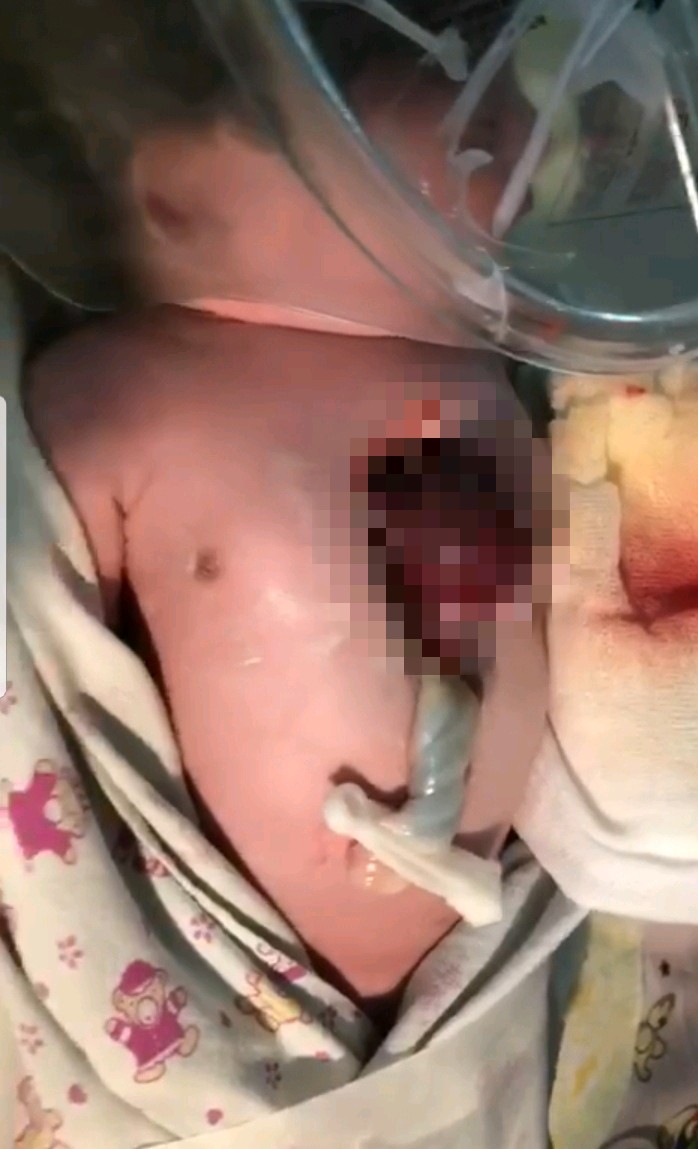 Niña nace con el corazón expuesto en San Lucas